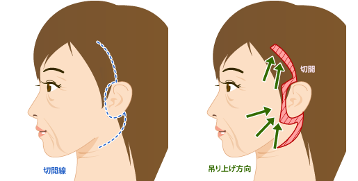 フェイスリフトの手術方法