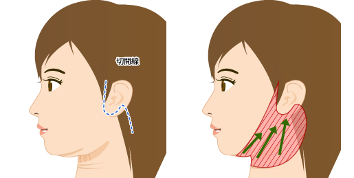 ネックリフトの手術方法