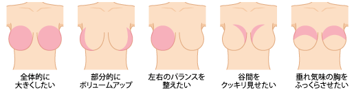 ヒアルロン酸注入豊胸術