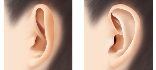立ち耳の手術法