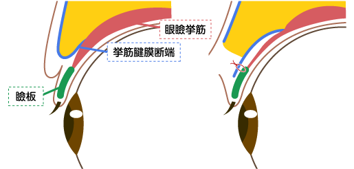 眼瞼下垂の手術方法