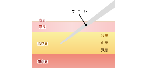 脂肪吸引の手術法