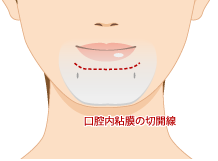 エラ骨切り手術