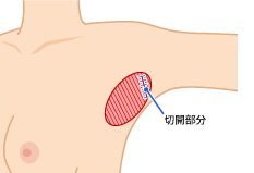 剪除法の手術法