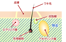 剪除法の手術法