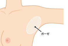 剪除法の手術法