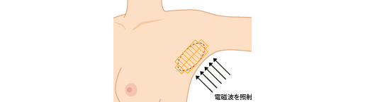 ミラドライでワキガ再発