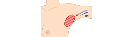 吸引法でワキガ再発