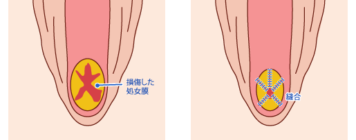 処女膜再生の手術法 仙台中央クリニック 福島 山形 岩手