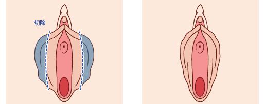 小陰唇縮小術